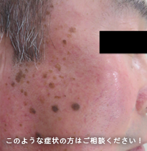 顔のイボ（脂漏性角化症）・ホクロ（母斑細胞母斑）